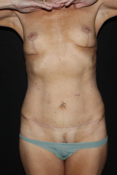 Abdominoplasty (With Diastasis) Before & After Gallery - Patient 405673 - Image 2