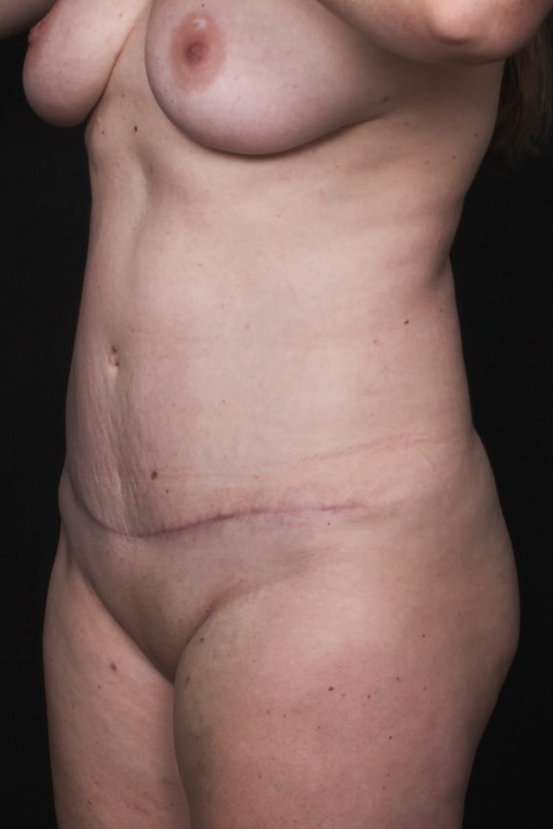 Abdominoplasty (With Diastasis) Before & After Gallery - Patient 250581 - Image 4