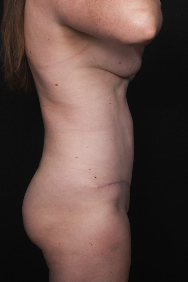 Abdominoplasty (With Diastasis) Before & After Gallery - Patient 250581 - Image 8