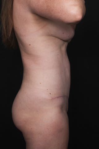 Abdominoplasty Before & After Gallery - Patient 412221 - Image 8