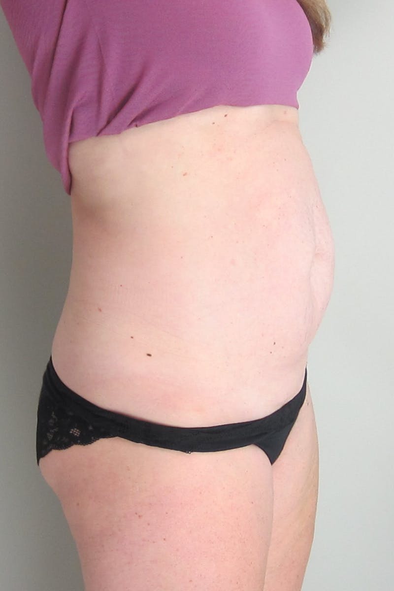 Abdominoplasty (With Diastasis) Before & After Gallery - Patient 250581 - Image 7