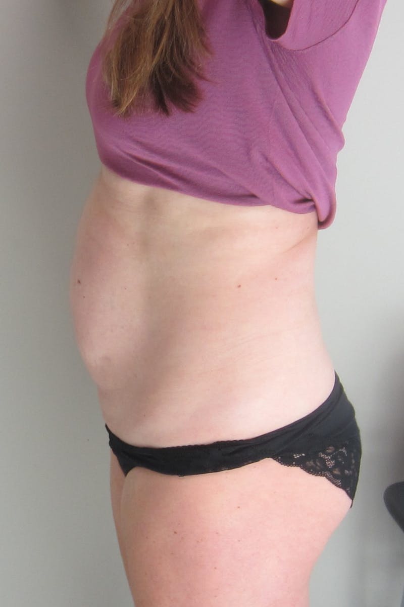 Abdominoplasty (With Diastasis) Before & After Gallery - Patient 250581 - Image 5