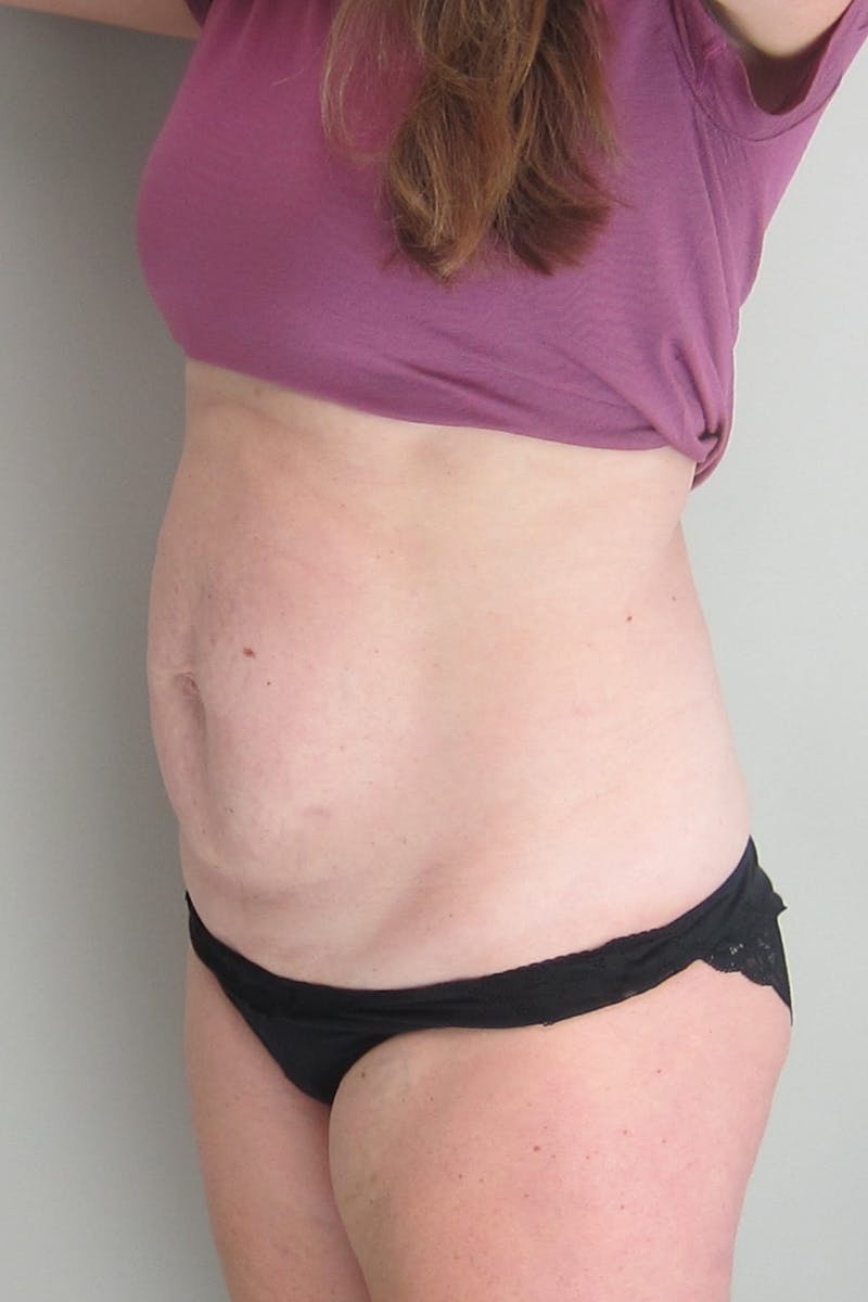 Abdominoplasty Before & After Gallery - Patient 412221 - Image 3