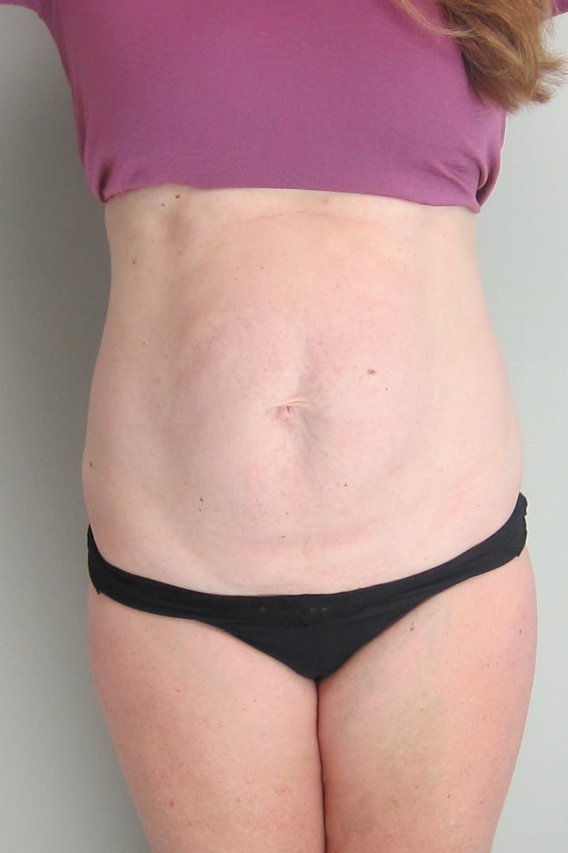 Abdominoplasty Before & After Gallery - Patient 412221 - Image 1