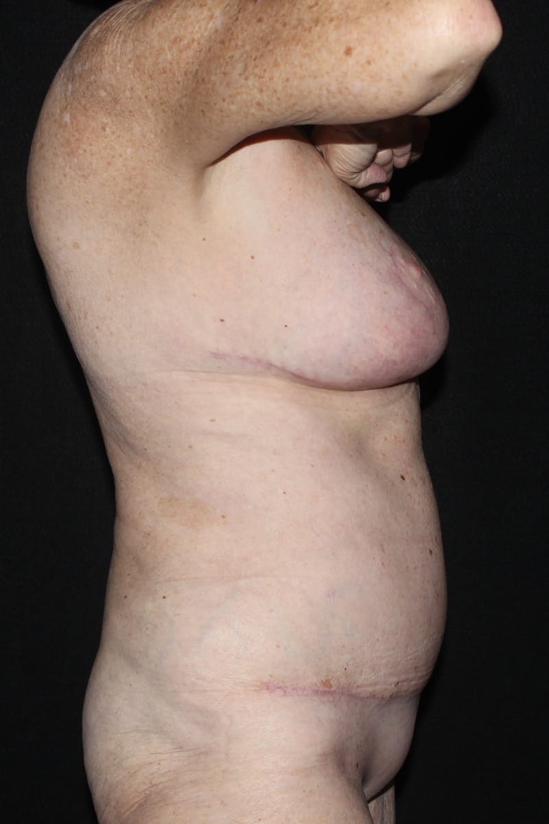 Abdominoplasty (With Diastasis) Before & After Gallery - Patient 327344 - Image 6