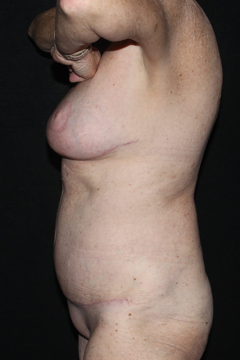 Abdominoplasty (With Diastasis) Before & After Gallery - Patient 327344 - Image 8