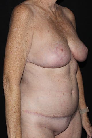 Abdominoplasty Before & After Gallery - Patient 338081 - Image 4