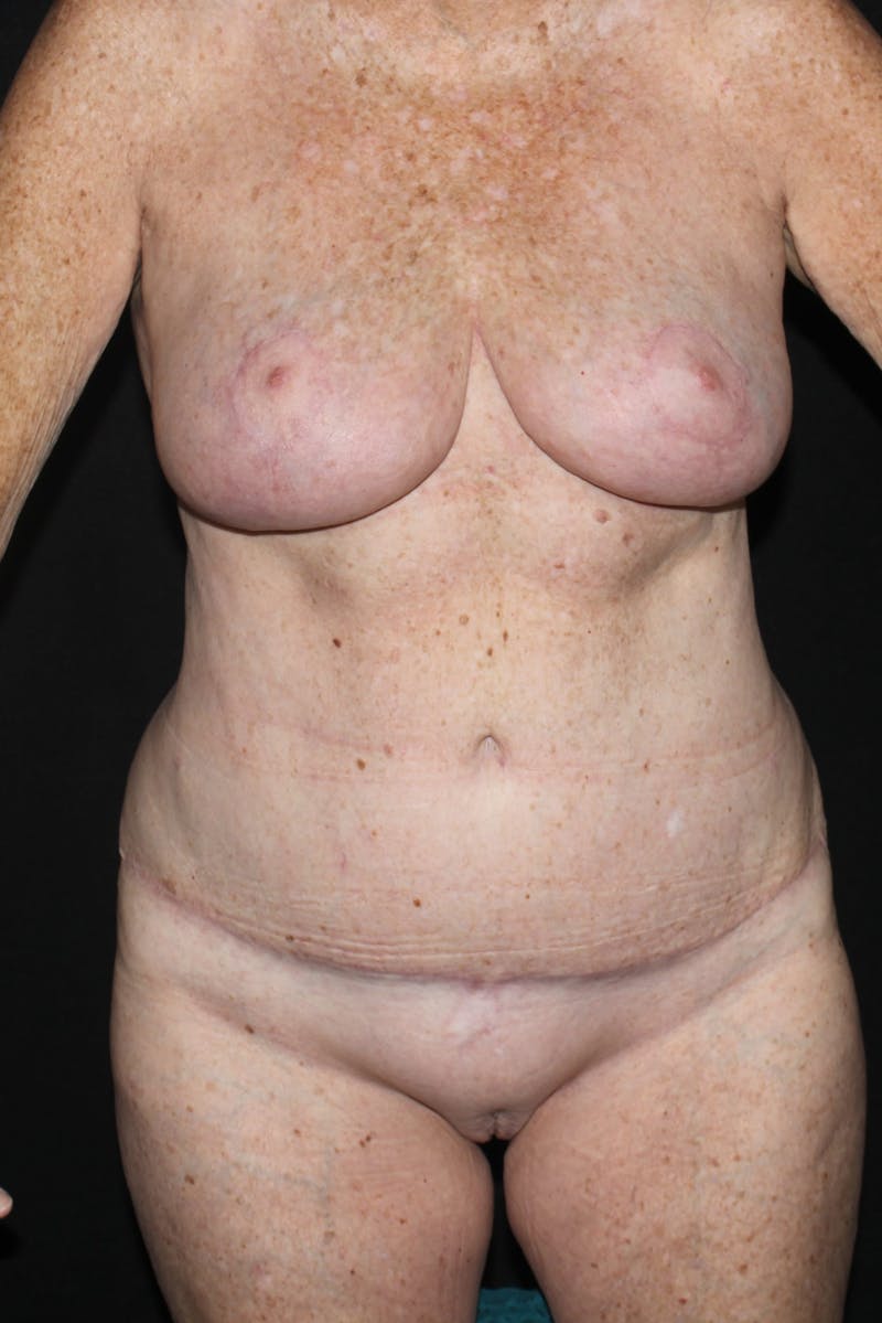Abdominoplasty Before & After Gallery - Patient 338081 - Image 2