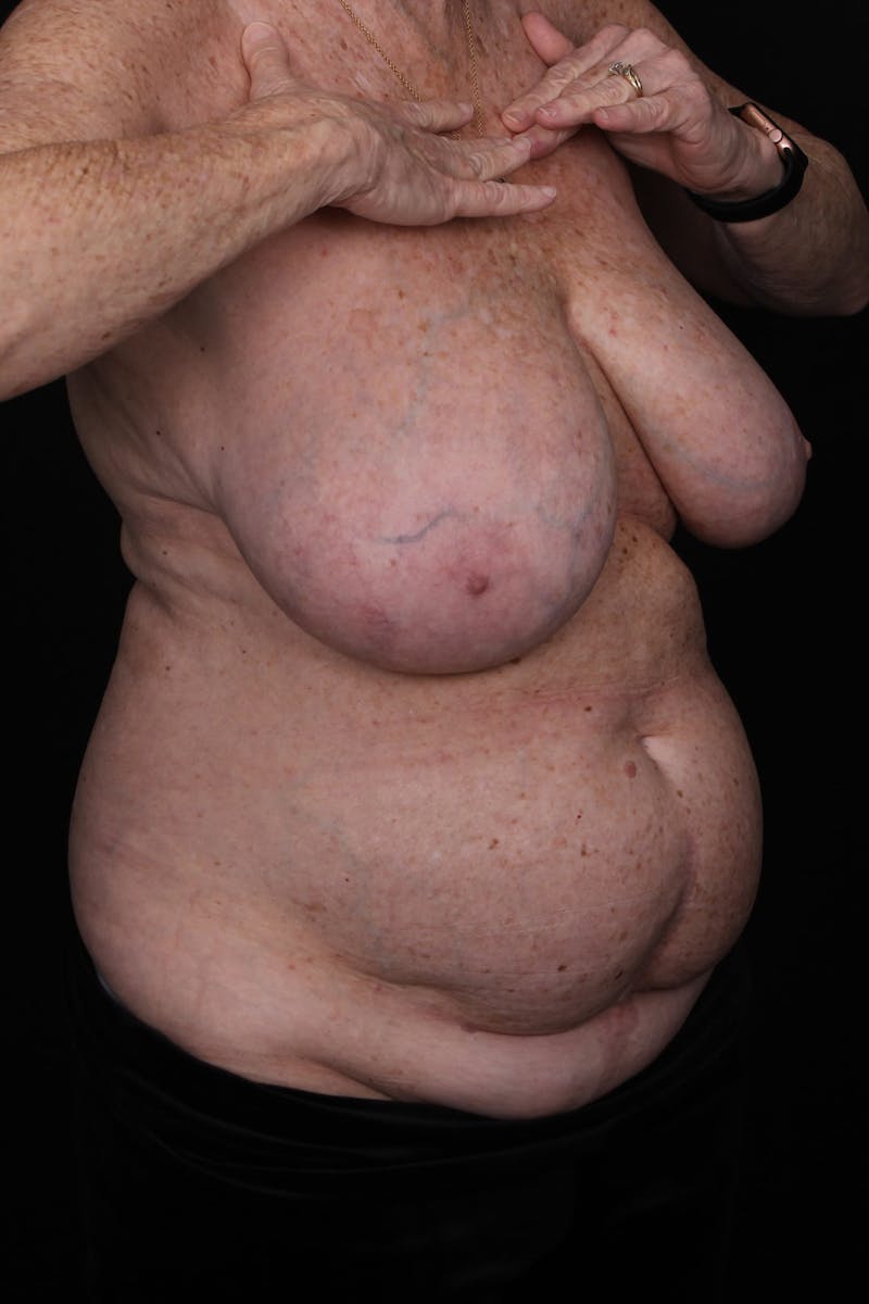 Abdominoplasty Before & After Gallery - Patient 338081 - Image 3