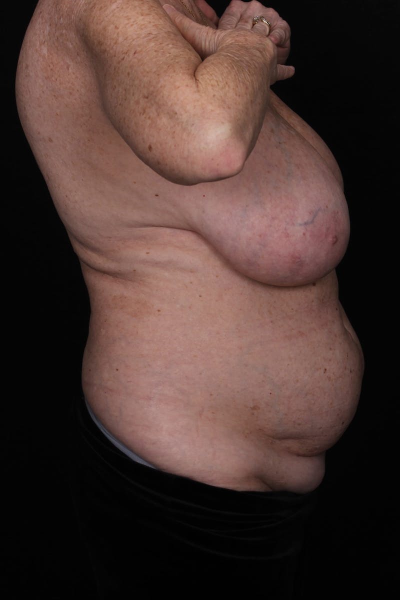 Abdominoplasty Before & After Gallery - Patient 338081 - Image 5
