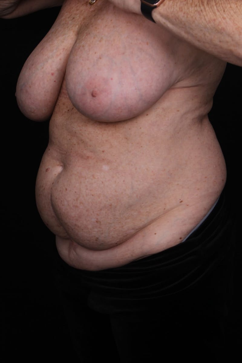 Abdominoplasty (With Diastasis) Before & After Gallery - Patient 327344 - Image 9