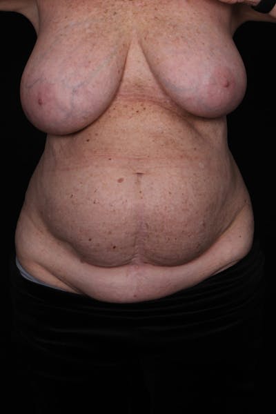 Abdominoplasty Before & After Gallery - Patient 338081 - Image 1