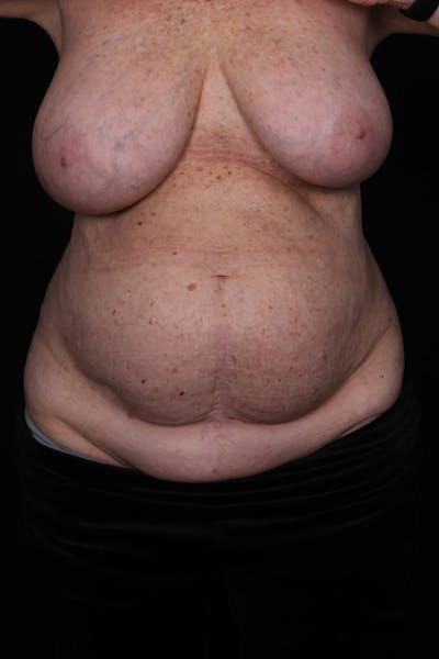 Abdominoplasty (With Diastasis) Before & After Gallery - Patient 327344 - Image 1