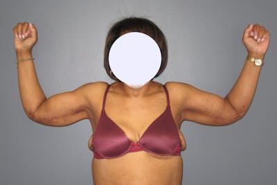 Brachioplasty Before & After Gallery - Patient 356184 - Image 2