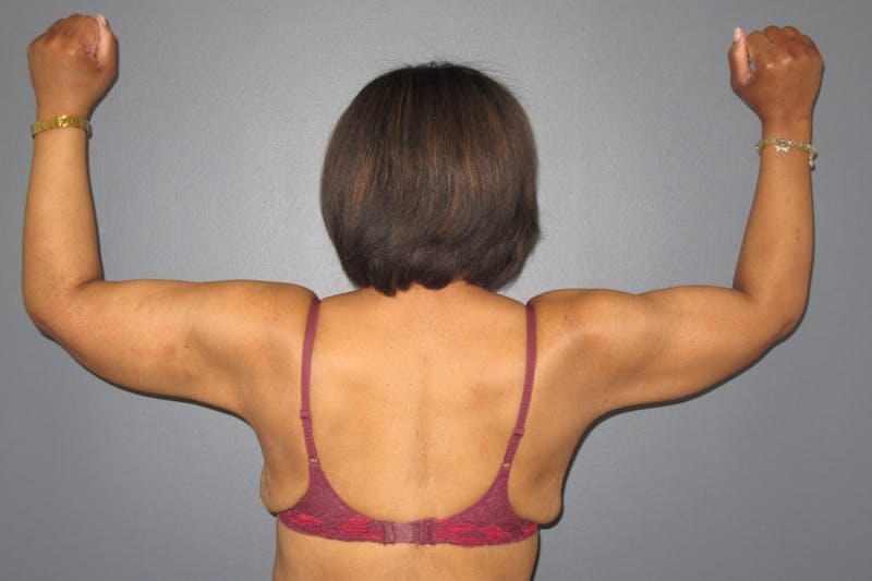 Brachioplasty Before & After Gallery - Patient 356184 - Image 4