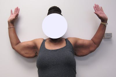 Brachioplasty Before & After Gallery - Patient 927366 - Image 1