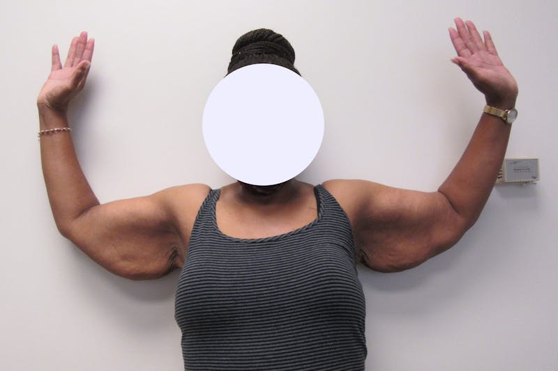 Brachioplasty Before & After Gallery - Patient 927366 - Image 1