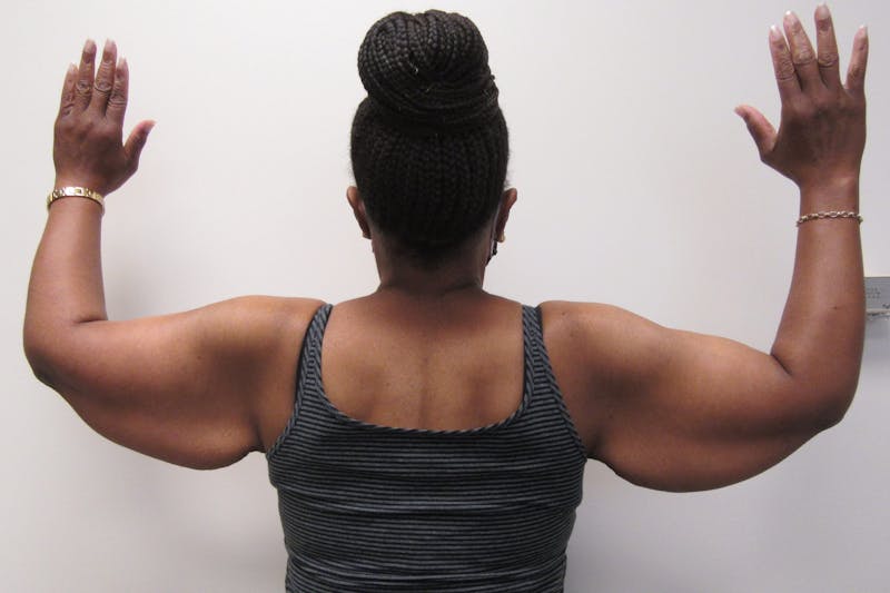 Brachioplasty Before & After Gallery - Patient 927366 - Image 3
