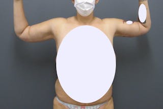 Brachioplasty Before & After Gallery - Patient 211535 - Image 2