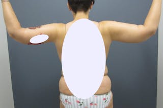 Brachioplasty Before & After Gallery - Patient 211535 - Image 4