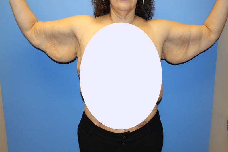 Brachioplasty Before & After Gallery - Patient 211535 - Image 1