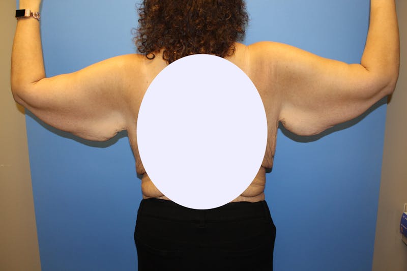 Brachioplasty Before & After Gallery - Patient 211535 - Image 3