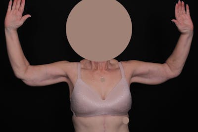 Brachioplasty Before & After Gallery - Patient 470106 - Image 2
