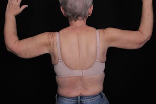 Brachioplasty Before & After Gallery - Patient 375391 - Image 4