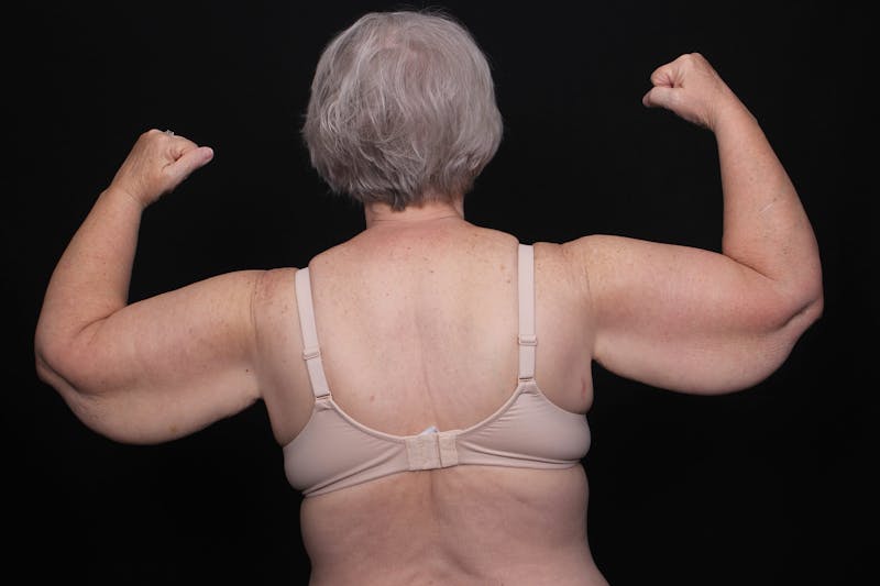 Brachioplasty Before & After Gallery - Patient 375391 - Image 3