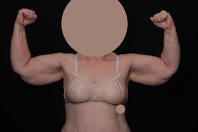 Brachioplasty Before & After Gallery - Patient 375391 - Image 1