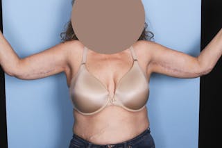 Brachioplasty Before & After Gallery - Patient 840045 - Image 2