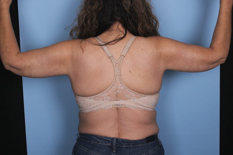 Brachioplasty Before & After Gallery - Patient 424005 - Image 4