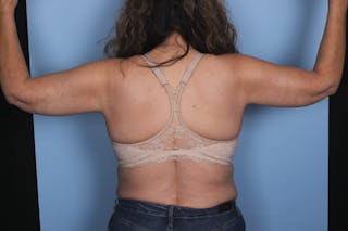 Brachioplasty Before & After Gallery - Patient 840045 - Image 4
