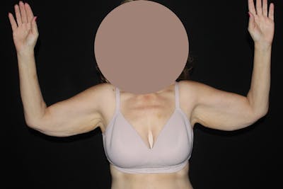 Brachioplasty Before & After Gallery - Patient 840045 - Image 1