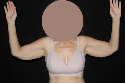 Brachioplasty Before & After Gallery - Patient 424005 - Image 1