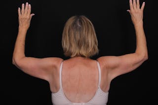 Brachioplasty Before & After Gallery - Patient 292472 - Image 4