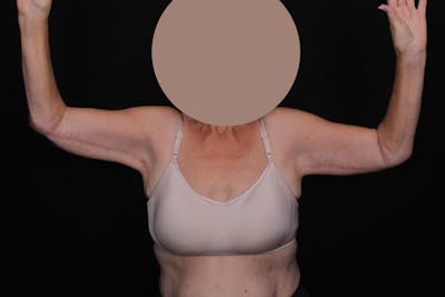 Brachioplasty Before & After Gallery - Patient 292472 - Image 2