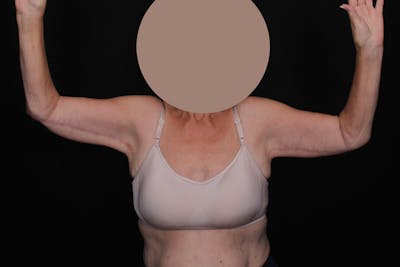 Brachioplasty Before & After Gallery - Patient 404910 - Image 2