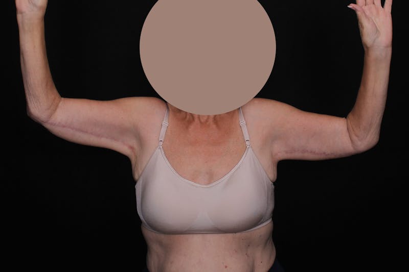 Brachioplasty Before & After Gallery - Patient 404910 - Image 2