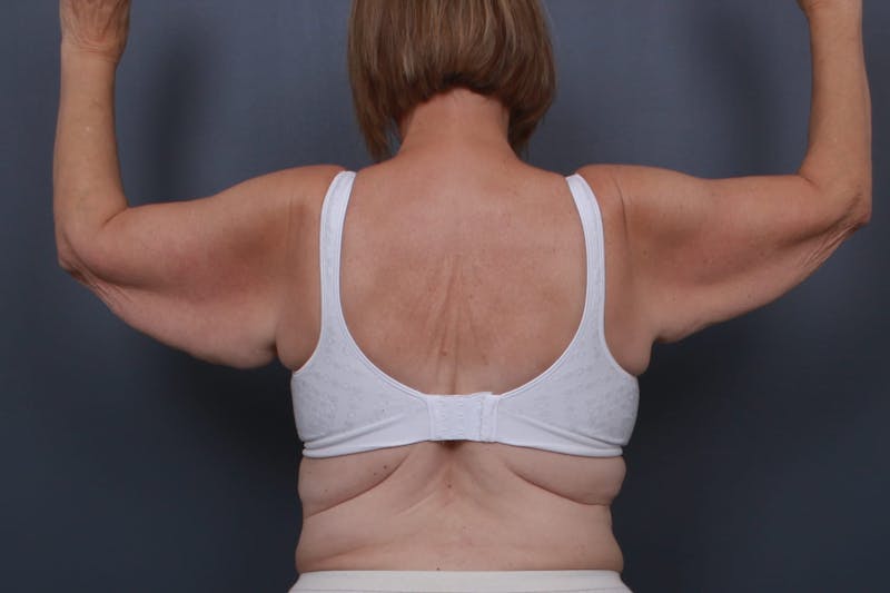 Brachioplasty Before & After Gallery - Patient 404910 - Image 3