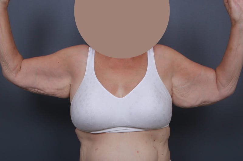 Brachioplasty Before & After Gallery - Patient 404910 - Image 1