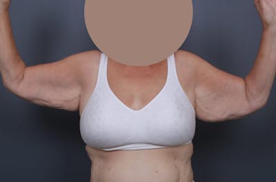 Brachioplasty Before & After Gallery - Patient 404910 - Image 1