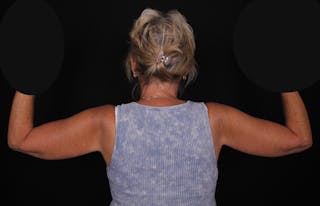 Brachioplasty Before & After Gallery - Patient 375288 - Image 4