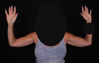 Brachioplasty Before & After Gallery - Patient 375288 - Image 2