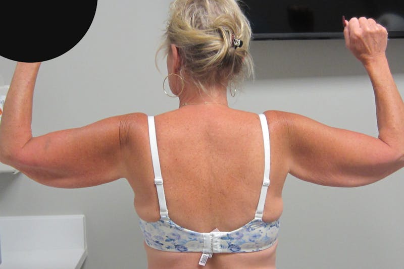 Brachioplasty Before & After Gallery - Patient 278892 - Image 3