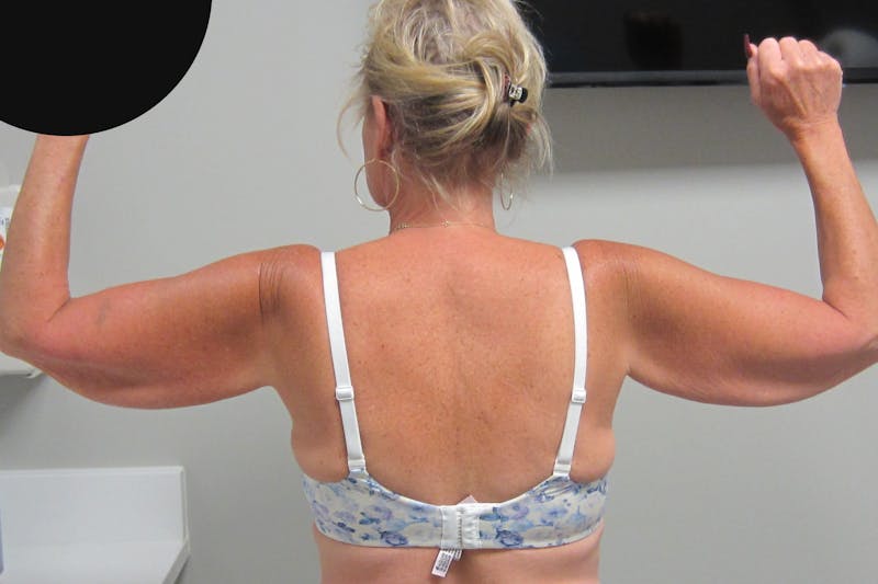 Brachioplasty Before & After Gallery - Patient 375288 - Image 3
