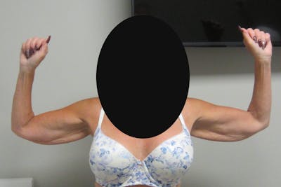Brachioplasty Before & After Gallery - Patient 375288 - Image 1