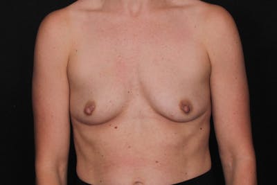 Breast Augmentation Before & After Gallery - Patient 280371 - Image 1