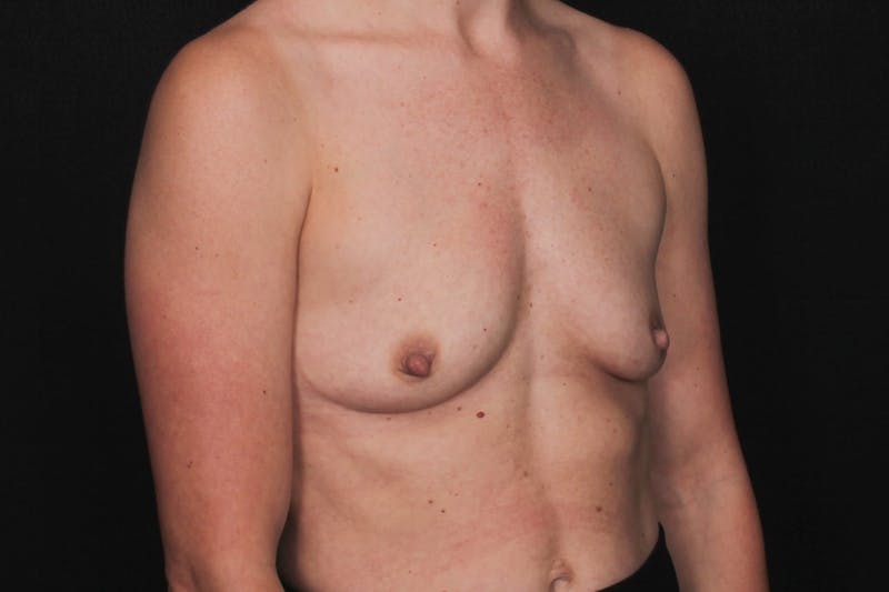 Breast Augmentation Before & After Gallery - Patient 280371 - Image 3