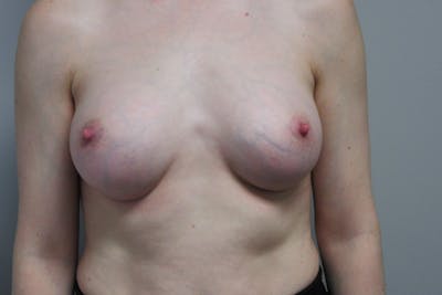 Breast Augmentation Before & After Gallery - Patient 108028 - Image 2